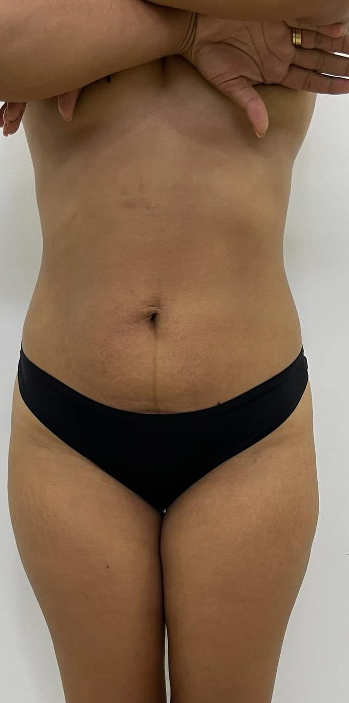 Antes y después de un tratamiento reductor corporal, después